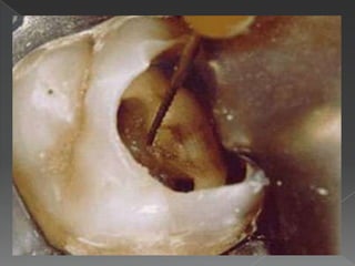 MEDIOS DE UNIÓNEntre ambos elementos existe el ligamento alvéolo dentario o periodonto, que va desde el alvéolo a la raíz.Inserción gingival (encía): inserción de la encía en el contorno del cuello del diente, lo cual además protege al periodonto.