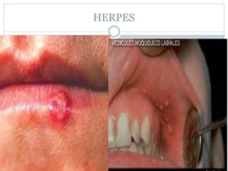 HERPES
 