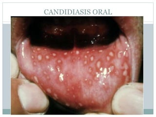 CANDIDIASIS ORAL
 