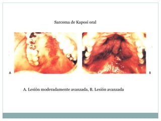 Sarcoma de Kaposi oral
A. Lesión moderadamente avanzada, B. Lesión avanzada
 