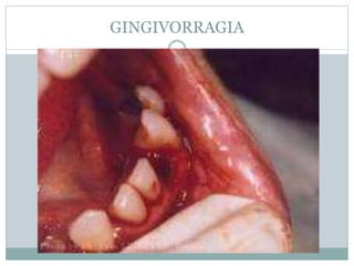 GINGIVORRAGIA
 