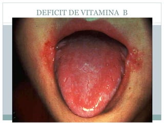 DEFICIT DE VITAMINA B
 