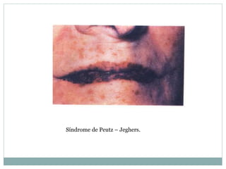 Síndrome de Peutz – Jeghers.
 