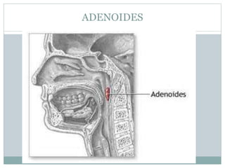ADENOIDES
 