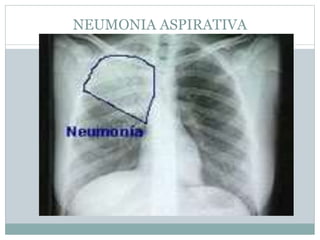 NEUMONIA ASPIRATIVA
 