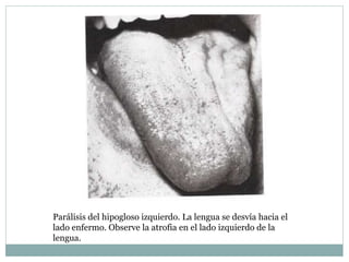 Parálisis del hipogloso izquierdo. La lengua se desvía hacia el
lado enfermo. Observe la atrofia en el lado izquierdo de la
lengua.
 