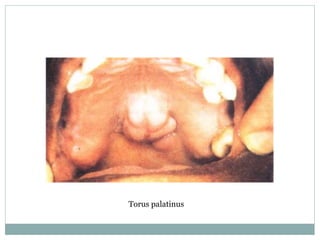 Torus palatinus
 