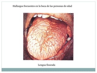 Lengua fisurada
Hallazgos frecuentes en la boca de las personas de edad
 