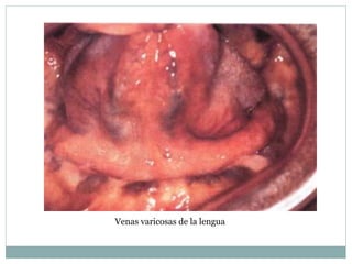 Venas varicosas de la lengua
 