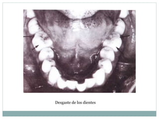 Desgaste de los dientes
 