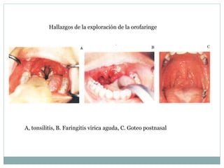 Hallazgos de la exploración de la orofaringe
A, tonsilitis, B. Faringitis virica aguda, C. Goteo postnasal
 