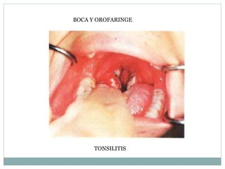 BOCA Y OROFARINGE
TONSILITIS
 