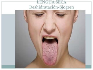 LENGUA SECA
Deshidratación-Sjogren
 