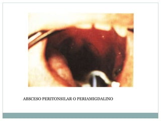 ABSCESO PERITONSILAR O PERIAMIGDALINO
 