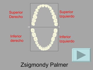 Zsigmondy Palmer Superior Derecho Superior Izquierdo Inferior derecho Inferior Izquierdo 
