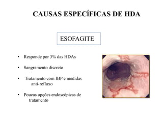 CAUSAS ESPECĺFICAS DE HDA
ESOFAGITE
• Responde por 3% das HDAs
• Sangramento discreto
• Tratamento com IBP e medidas
anti-refluxo
• Poucas opções endoscópicas de
tratamento
 