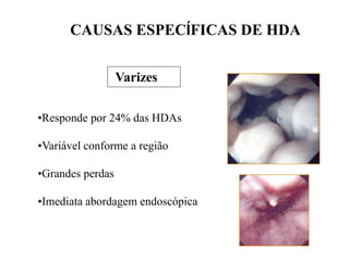 Varizes
•Responde por 24% das HDAs
•Variável conforme a região
•Grandes perdas
•Imediata abordagem endoscópica
CAUSAS ESPECĺFICAS DE HDA
 