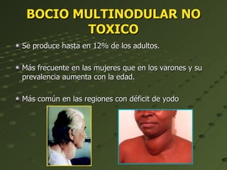 BOCIO MULTINODULAR NO TOXICO Se produce hasta en 12% de los adultos.  Más frecuente en las mujeres que en los varones y su prevalencia aumenta con la edad.  Más común en las regiones con déficit de yodo  