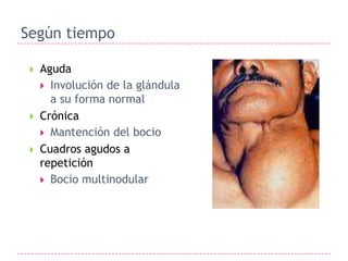 Según tiempo

    Aguda
      Involución de la glándula
       a su forma normal
    Crónica
      Mantención del bocio
    Cuadros agudos a
     repetición
      Bocio multinodular
 