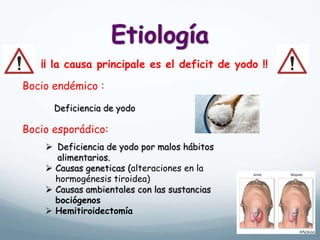 ¡¡ la causa principale es el deficit de yodo !!
Bocio endémico :
Deficiencia de yodo
Bocio esporádico:
 Deficiencia de yodo por malos hábitos
alimentarios.
 Causas geneticas (alteraciones en la
hormogénesis tiroidea)
 Causas ambientales con las sustancias
bociógenos
 Hemitiroidectomía
 