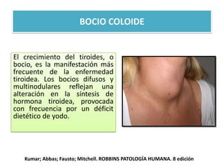 BOCIO COLOIDE
El crecimiento del tiroides, o
bocio, es la manifestación más
frecuente de la enfermedad
tiroidea. Los bocios difusos y
multinodulares reflejan una
alteración en la síntesis de
hormona tiroidea, provocada
con frecuencia por un déficit
dietético de yodo.
Kumar; Abbas; Fausto; Mitchell. ROBBINS PATOLOGÍA HUMANA. 8 edición
 