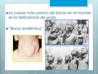 La causa más común de bocio en el mundo
es la deficiencia de yodo
“Bocio endémico”
 