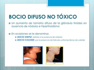 BOCIO DIFUSO NO TÓXICO
 Un aumento de tamaño difuso de la glándula tiroides en
ausencia de nódulos e hipertiroidismo
 En ocasiones se le denomina:
 BOCIO SIMPLE: debido a la ausencia de nódulos
 BOCIO COLOIDE: por la presencia de folículos uniformes llenos de coloide
 