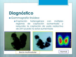 Diagnóstico
 Gammagrafía tiroidea:
 Captación heterogénea con múltiples
regiones de captación aumentada y
reducida; la captación de yodo radiactivo
de 24 h puede no estar aumentada
NormalBocio multinodular
 