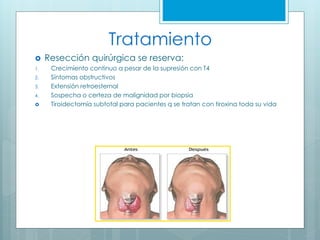 Tratamiento
 Resección quirúrgica se reserva:
1. Crecimiento continuo a pesar de la supresión con T4
2. Síntomas obstructivos
3. Extensión retroesternal
4. Sospecha o certeza de malignidad por biopsia
 Tiroidectomía subtotal para pacientes q se tratan con tiroxina toda su vida
 