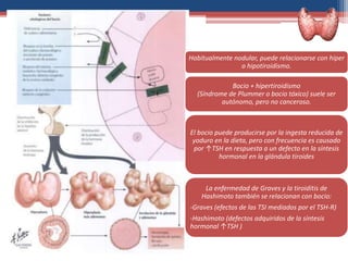 Habitualmente nodular, puede relacionarse con hiper
o hipotiroidismo.
Bocio + hipertiroidismo
(Síndrome de Plummer o bocio tóxico) suele ser
autónomo, pero no canceroso.
El bocio puede producirse por la ingesta reducida de
yoduro en la dieta, pero con frecuencia es causado
por ↑TSH en respuesta a un defecto en la síntesis
hormonal en la glándula tiroides
La enfermedad de Graves y la tiroiditis de
Hashimoto también se relacionan con bocio:
-Graves (efectos de las TSI mediados por el TSH-R)
-Hashimoto (defectos adquiridos de la síntesis
hormonal ↑TSH )
 