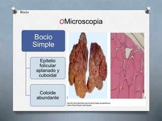 OMicroscopia
Bocio
Simple
Epitelio
folicular
aplanado y
cuboidal
Coloide
abundante
Bocio
 