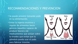 RECONMENDACIONES Y PREVENCION
• Se puede prevenir tomando yodo
en su alimentación.
• Evitar la ingesta excesiva y
regular de alimentos bocio
génicos (aquellos capaces de
producir bocio) y de
medicamentos que actúan sobre
la tiroides que evitan que la
glándula pueda usar el yodo
para fabricar tiroxina.
 