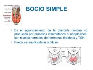 BOCIO SIMPLE

• Es el agrandamiento de la glándula tiroidea no
producido por procesos inflamatorios ni neoplásicos,
con niveles normales de hormonas tiroideas y TSH.
• Puede ser multinodular o difuso.

 