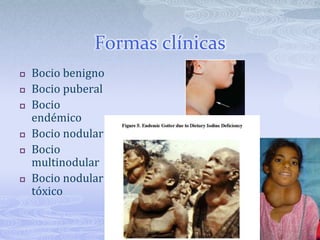 Formas clínicas
   Bocio benigno
   Bocio puberal
   Bocio
    endémico
   Bocio nodular
   Bocio
    multinodular
   Bocio nodular
    tóxico
 