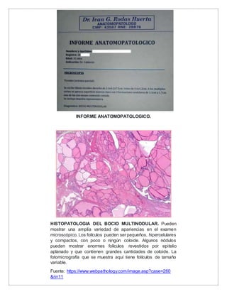BOCIO MULTINODULAR UNILATERAL. | DOCX