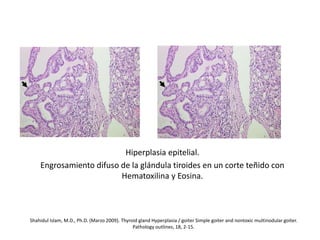 Hiperplasia epitelial.
Engrosamiento difuso de la glándula tiroides en un corte teñido con
Hematoxilina y Eosina.
Shahidul Islam, M.D., Ph.D. (Marzo 2009). Thyroid gland Hyperplasia / goiter Simple goiter and nontoxic multinodular goiter.
Pathology outlines, 18, 2-15.
 