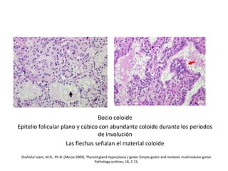 Bocio coloide
Epitelio folicular plano y cúbico con abundante coloide durante los períodos
de involución
Las flechas señalan el material coloide
Shahidul Islam, M.D., Ph.D. (Marzo 2009). Thyroid gland Hyperplasia / goiter Simple goiter and nontoxic multinodular goiter.
Pathology outlines, 18, 2-15.
 