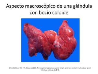 Aspecto macroscópico de una glándula
con bocio coloide
Shahidul Islam, M.D., Ph.D. (Marzo 2009). Thyroid gland Hyperplasia / goiter Simple goiter and nontoxic multinodular goiter.
Pathology outlines, 18, 2-15.
 