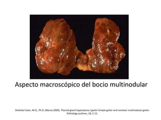 Aspecto macroscópico del bocio multinodular
Shahidul Islam, M.D., Ph.D. (Marzo 2009). Thyroid gland Hyperplasia / goiter Simple goiter and nontoxic multinodular goiter.
Pathology outlines, 18, 2-15.
 