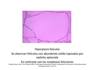 Hiperplasia folicular
Se observan folículos con abundante colide tapizados por
epitelio aplanado
En contraste con las neoplasias foliculares
Shahidul Islam, M.D., Ph.D. (Marzo 2009). Thyroid gland Hyperplasia / goiter Simple goiter and nontoxic multinodular goiter.
Pathology outlines, 18, 2-15.
 