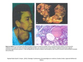 Bocio no tóxico A. En una mujer de edad avanzada con bocio no tóxico la tiroides sufrió crecimiento hasta originar una tumoración
evidente en el cuello. B. Corte coronal de la glándula tiroides con crecimiento que revela nódulos irregulares numerosos, algunos
presentan degeneración quística. C. Microfotografía de uno de los nódulos macroscópicos, que muestra variación intensa donde el tamaño
de los folículos.
Raphael Rubin David S. Strayer . (2012). Patología: Fundamentos clinicopatológicos en medicina. Estados Unidos: Lippincott Williams &
Wilkins .
 