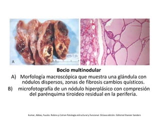 Bocio multinodular
A) Morfología macroscópica que muestra una glándula con
nódulos dispersos, zonas de fibrosis cambios quísticos.
B) microfotografía de un nódulo hiperplásico con compresión
del parénquima tiroideo residual en la periferia.
Kumar, Abbas, Fausto. Robins y Cotran Patología estructural y funcional. Octava edición. Editorial Elsevier Sanders
 