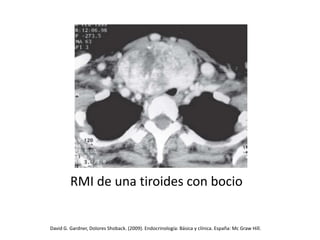 RMI de una tiroides con bocio
David G. Gardner, Dolores Shoback. (2009). Endocrinología: Básica y clínica. España: Mc Graw Hill.
 