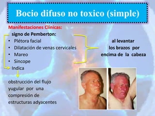 Manifestaciones Clínicas:
signo de Pemberton:
• Plétora facial al levantar
• Dilatación de venas cervicales los brazos por
• Mareo encima de la cabeza
• Sincope
Indica
obstrucción del flujo
yugular por una
compresión de
estructuras adyacentes
Bocio difuso no toxico (simple)
 
