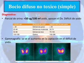 Diagnostico:
• Parcial de orina: <50 ug/100 ml yodo, apoyan el Dx. Déficit de yodo
• Gammagrafía: se ve el aumento en la captación en el déficit de
yodo.
Bocio difuso no toxico (simple)
 
