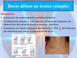 Tratamiento:
• Sustitución de yodo (regresión variable del bocio)
• Tiroidectomía subtotal o casi subtotal: compresión traqueal o de
obstrucción del estrecho torácico superior , estéticos.
• Sustitutivo con levotiroxina para mantener las C TSH + del intervalo
de referencia para evitar la reaparición de bocio
Bocio difuso no toxico (simple)
 