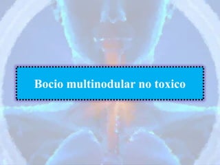 Bocio multinodular no toxico
 