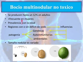 • Se producen hasta un 12% en adultos
• +frecuente en mujeres
• Prevalencia con la edad
• Regiones con o sin déficit de yodo influencias
Genéticas
patogenia Autoinmunitarias
ambientales
• Tamaño nodular es variado
Bocio multinodular no toxico
 