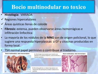 • Histología: VARIADA
 Regiones hipercelulares
 Áreas quísticas llenas de coloide
• Fibrosis: extensa, pueden observarse áreas hemorrágicas e
infiltración linfocítica
• La mayoría de los nódulos de la MNG son de origen policlonal, lo que
sugiere una respuesta hiperplasicas a GF y citocinas producidas en
forma local.
• TSH normal papel permisivo o contribuye al trastorno.
Bocio multinodular no toxico
 