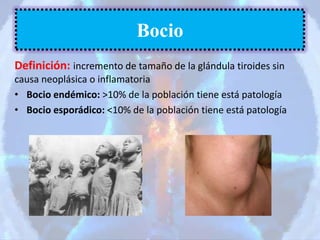 Definición: incremento de tamaño de la glándula tiroides sin
causa neoplásica o inflamatoria
• Bocio endémico: >10% de la población tiene está patología
• Bocio esporádico: <10% de la población tiene está patología
Bocio
 